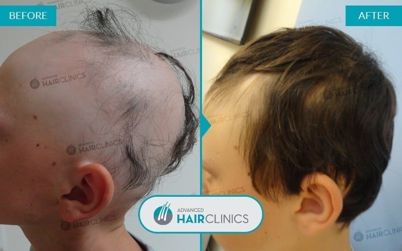 Autologous hair mesotherapy after 6 sessions, before and after treatment, left side. Result 001.