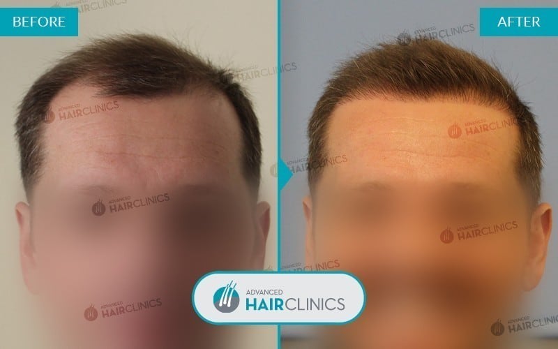 Greffe de cheveux FUE avec 4.812 follicules. Avant et après le traitement, de face. Résultat 001.