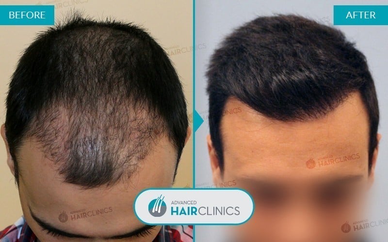 FUE hair transplant with 5.462 hair grafts. Before and after treatment, front. Result 002
