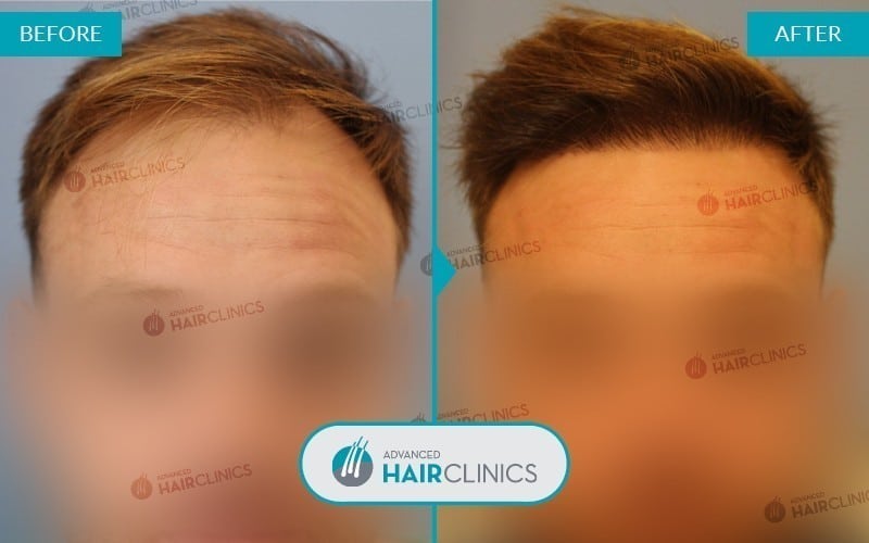 Greffe de cheveux FUE avec 2.057 follicules. Avant et après le traitement. Résultat 008.