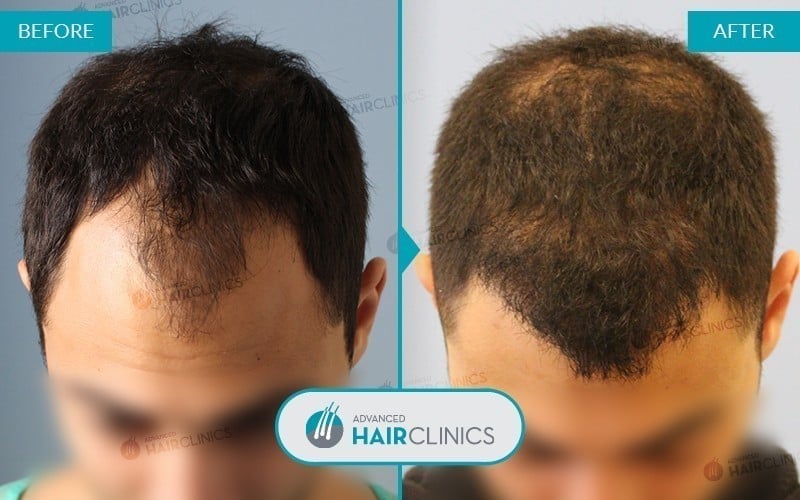 FUE Haartransplantation mit 1.742 Haarfollikel. Vor und nach der Behandlung. Ergebnis 011.