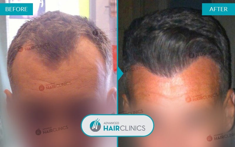 FUE Haartransplantation mit 1.261 Haarfollikel. Vor und nach der Behandlung. Ergebnis 028.