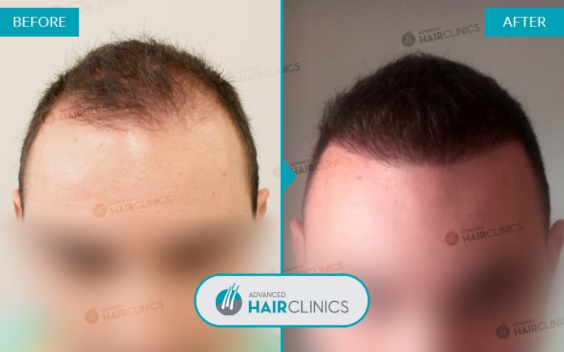 FUE Haartransplantation mit 2.695 Haarfollikel. Vor und nach der Behandlung. Ergebnis 038.