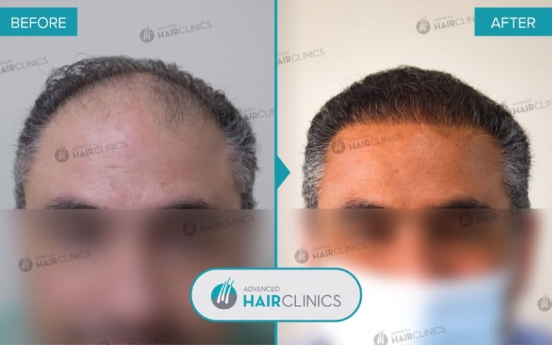 Greffe de cheveux FUE avec 3.530 follicules. Avant et après le traitement. Résultat 068.