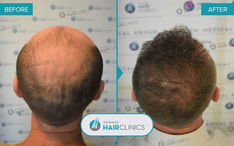 FUE hair transplant with 5.120 hair grafts. Before and after treatment. Result 081.