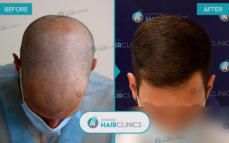 FUE hair transplant with 3.988 hair grafts. Before and after treatment. Result 082.