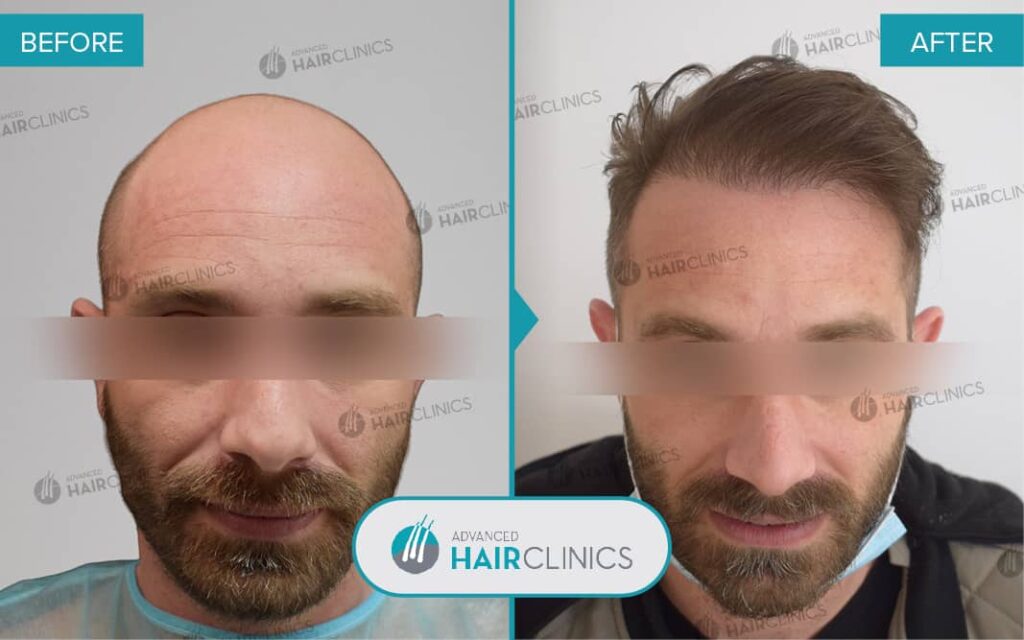 Greffe de cheveux FUE avec 3.464 follicules. Avant et après le traitement. Résultat 085.