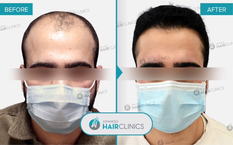 FUE hair transplant with 3.806 hair grafts. Before and after treatment. Result 089.