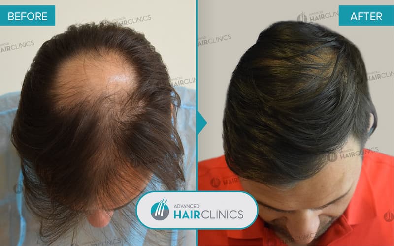 FUE hair transplant with 3.977 hair grafts. Before and after treatment. Result 094.
