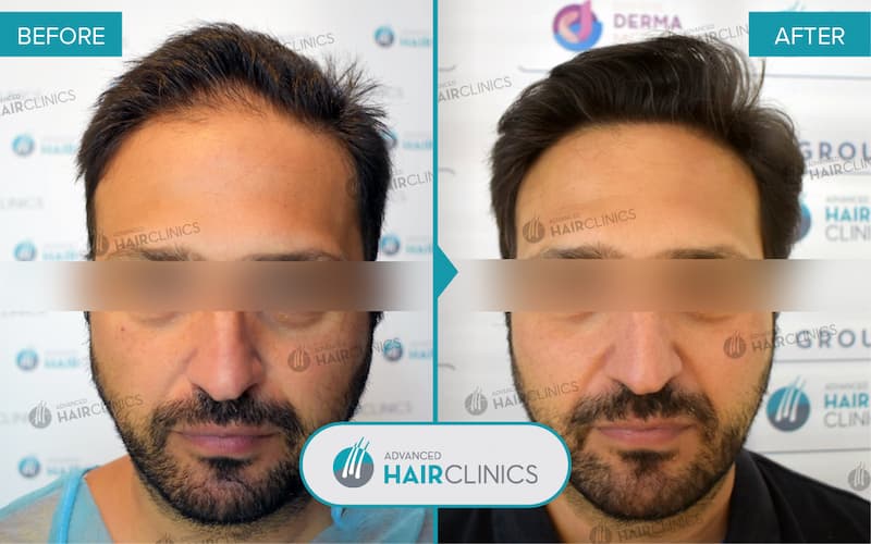 FUE Haartransplantation mit 4.149 Haarfollikel. Vor und nach der Behandlung. Ergebnis 095.