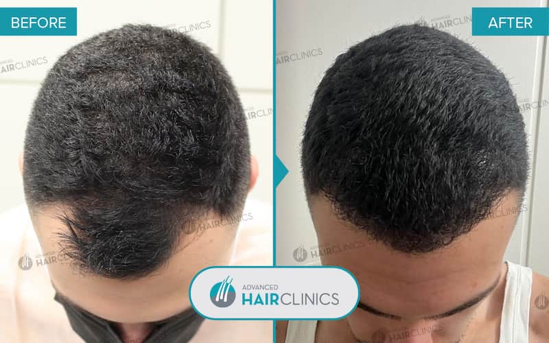 FUE hair transplant with 1.402 hair grafts. Before and after treatment. Result 105.