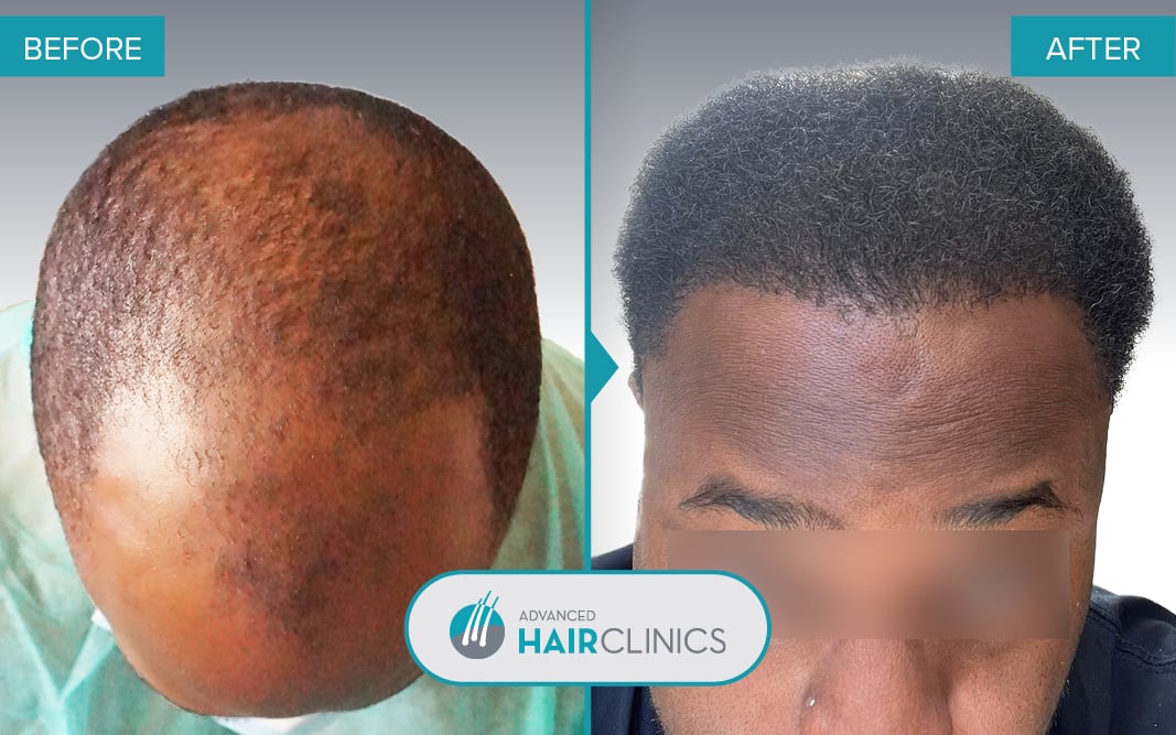 FUE hair transplant with 1.956 hair grafts. Before and after treatment. Result 112.