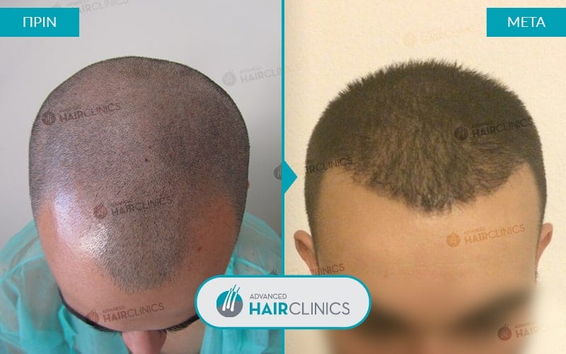 Μεταμόσχευση μαλλιών FUE με 1.323 τριχοθυλάκια, πριν και μετά την θεραπεία. Αποτέλεσμα 018.