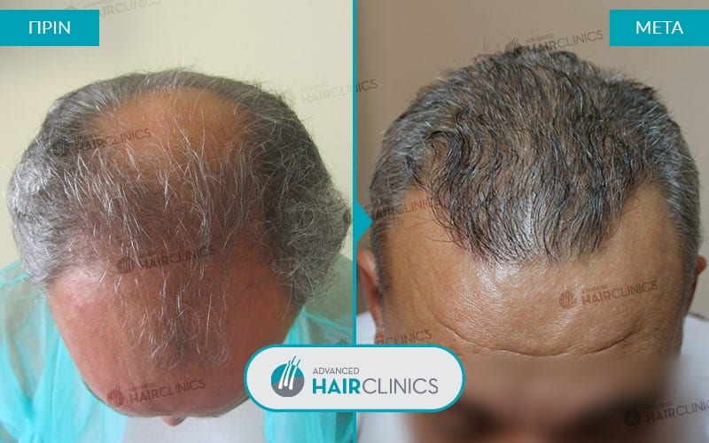 Μεταμόσχευση μαλλιών FUE με 1.660 τριχοθυλάκια, πριν και μετά την θεραπεία. Αποτέλεσμα 024.