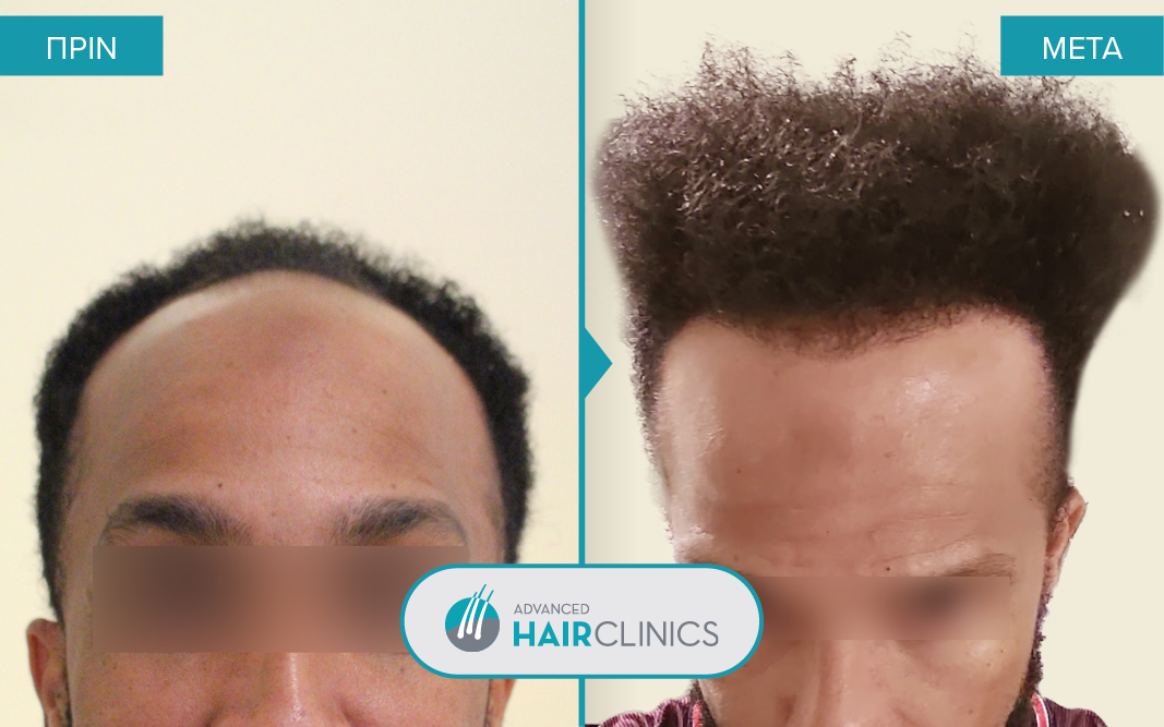 Μεταμόσχευση μαλλιών FUE με 1.536 τριχοθυλάκια, πριν και μετά την θεραπεία. Αποτέλεσμα 111.