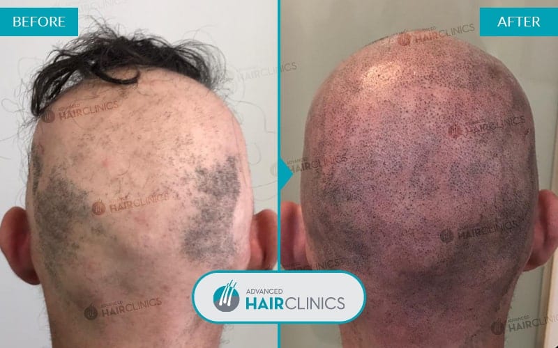 Mikropigmentierung der Kopfhaut nach 1 Sitzung. Vor und nach der Behandlung. Ergebnis 002.