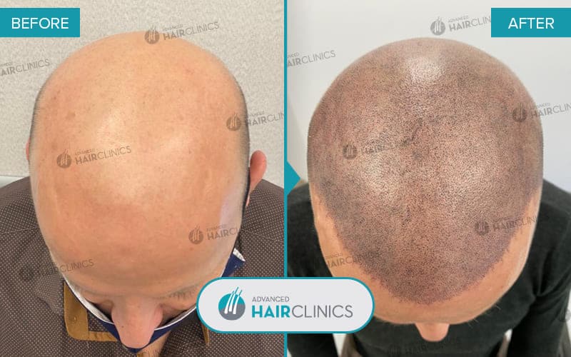Mikropigmentierung der Kopfhaut nach 3 Sitzung. Vor und nach der Behandlung. Ergebnis 006.
