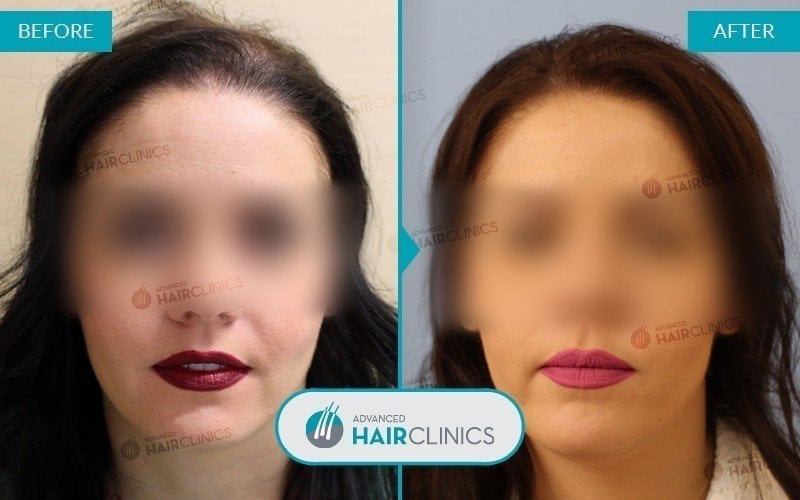 Unrasierte FUE-Haartransplantation mit 1.496 Haarfollikel. Vor und nach der Behandlung, vorderseite. Ergebnis 004.