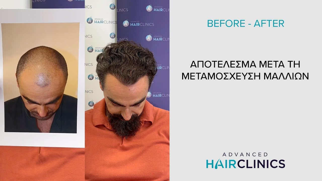 Μεταμόσχευση Μαλλιών - Δείτε Live το αποτέλεσμα μετά την εμφύτευση μαλλιών