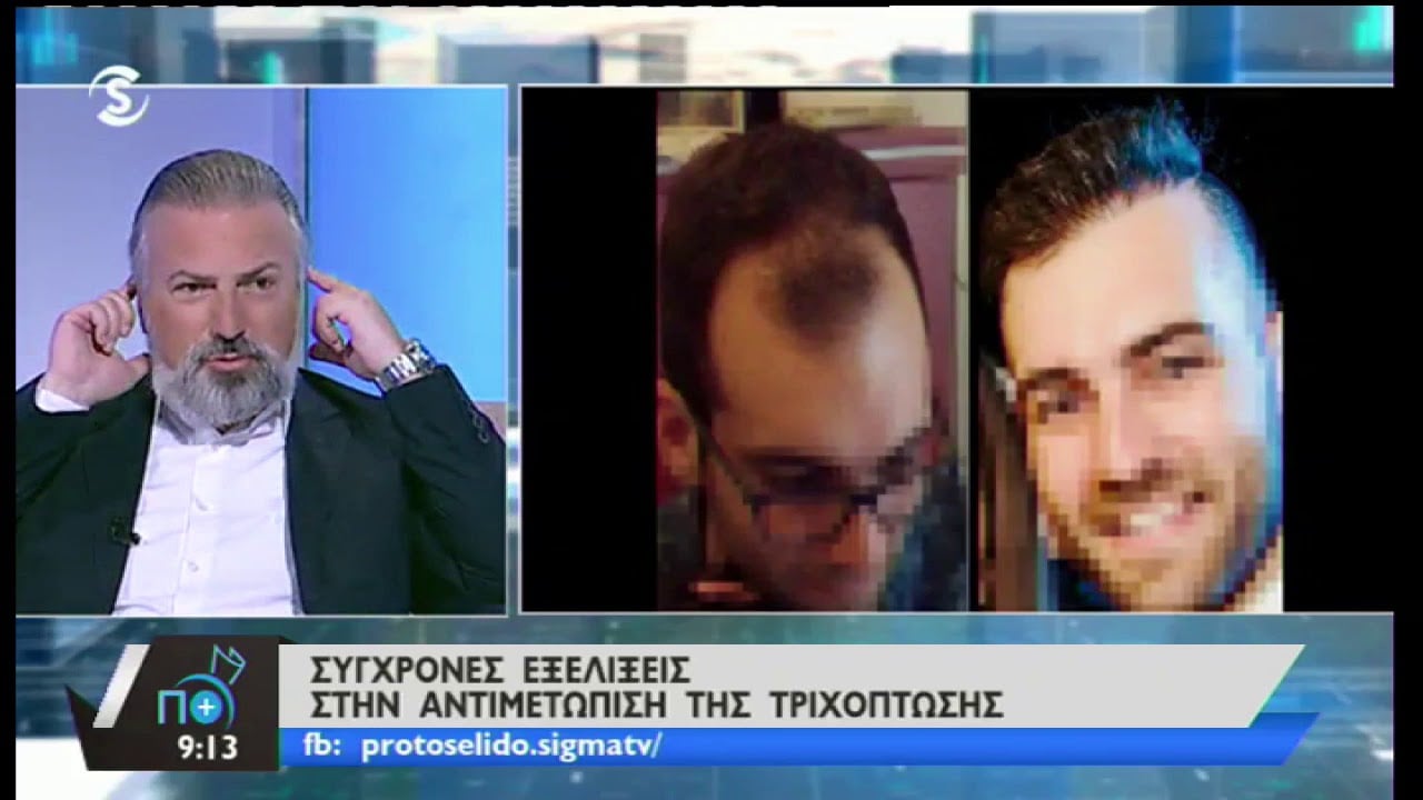 Η Τριχόπτωση και Σύγχρονες Εξελίξεις στην Αντιμετώπιση της